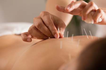 What Is Acupuncture